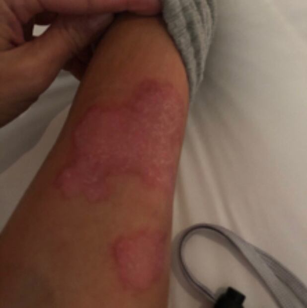 Kim Kardashian comparte impactantes imágenes de su cuerpo con psoriasis