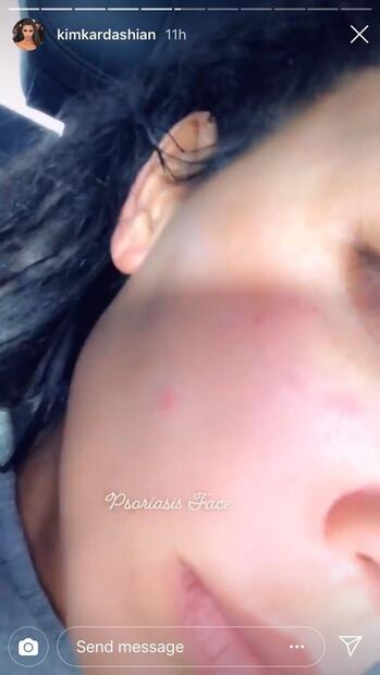Kim Kardashian comparte foto de su rostro con psoriasis