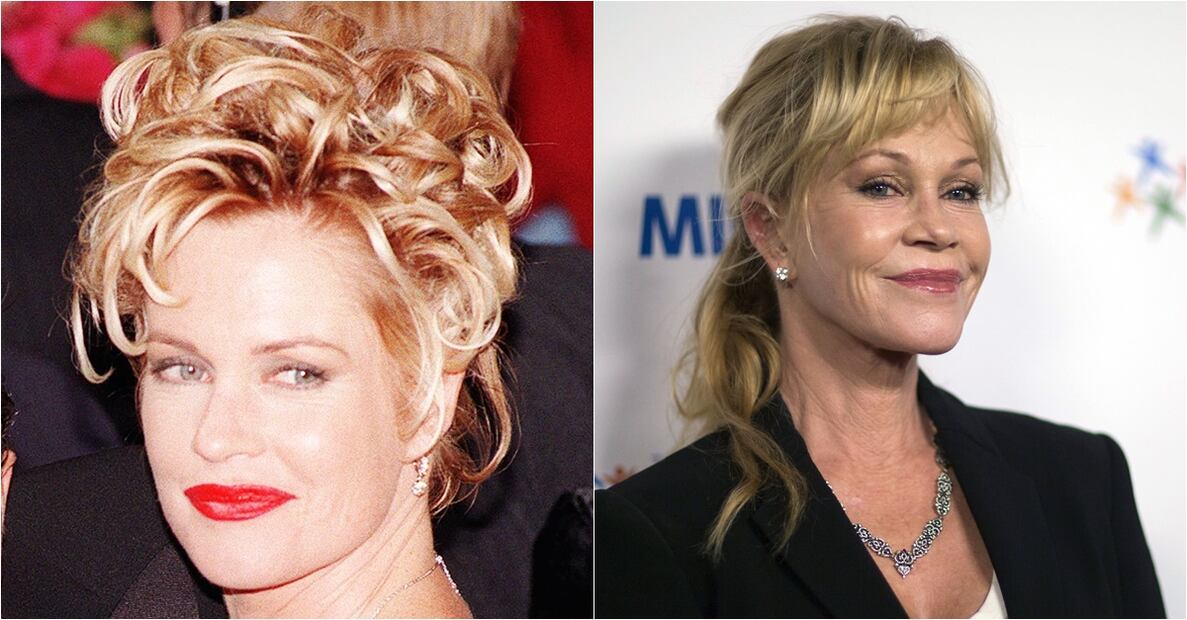 Famosos víctimas del botox 