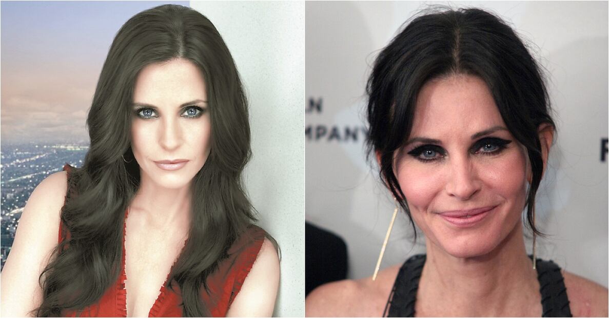 Famosos víctimas del botox 