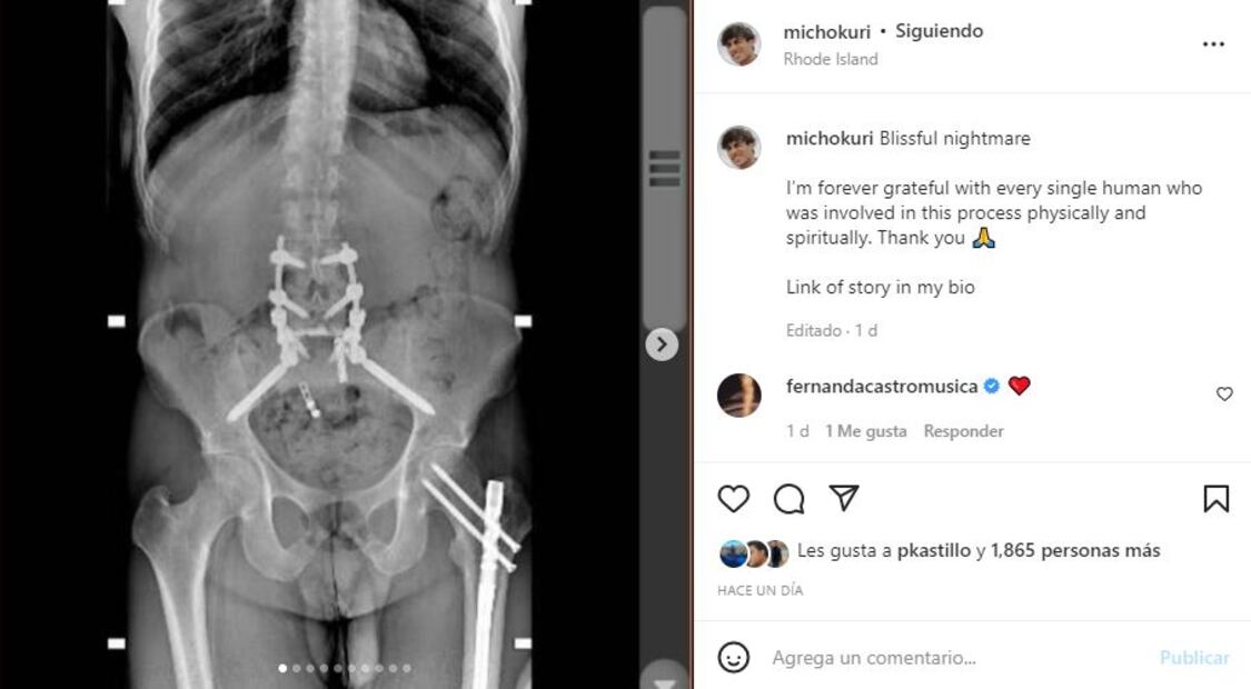 Micho Kuri: “La decisión más estúpida de mi vida”, sobre su accidente