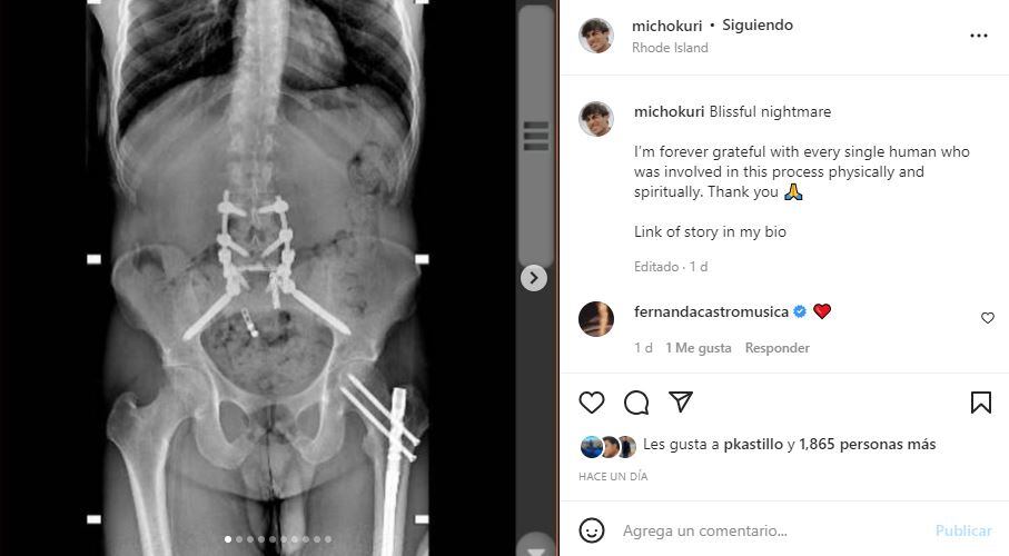 Micho Kuri: “La decisión más estúpida de mi vida”, sobre su accidente
