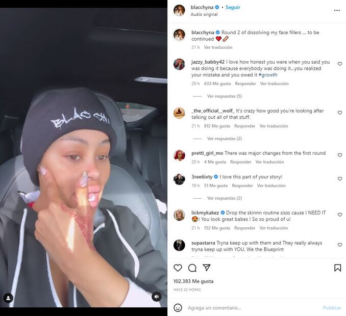 Blac Chyna, ex de Rob Kardashian, se transforma y se retira rellenos faciales