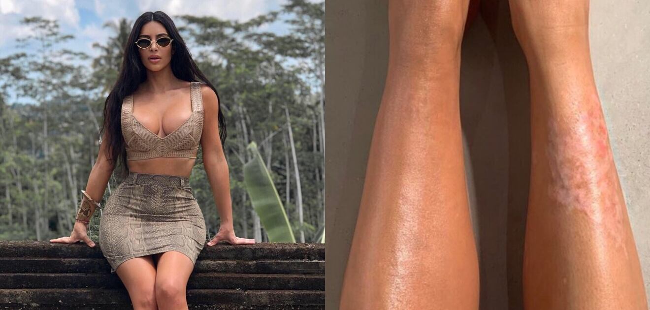 Kim Kardashian revela su truco para cubrir la psoriasis de sus piernas
