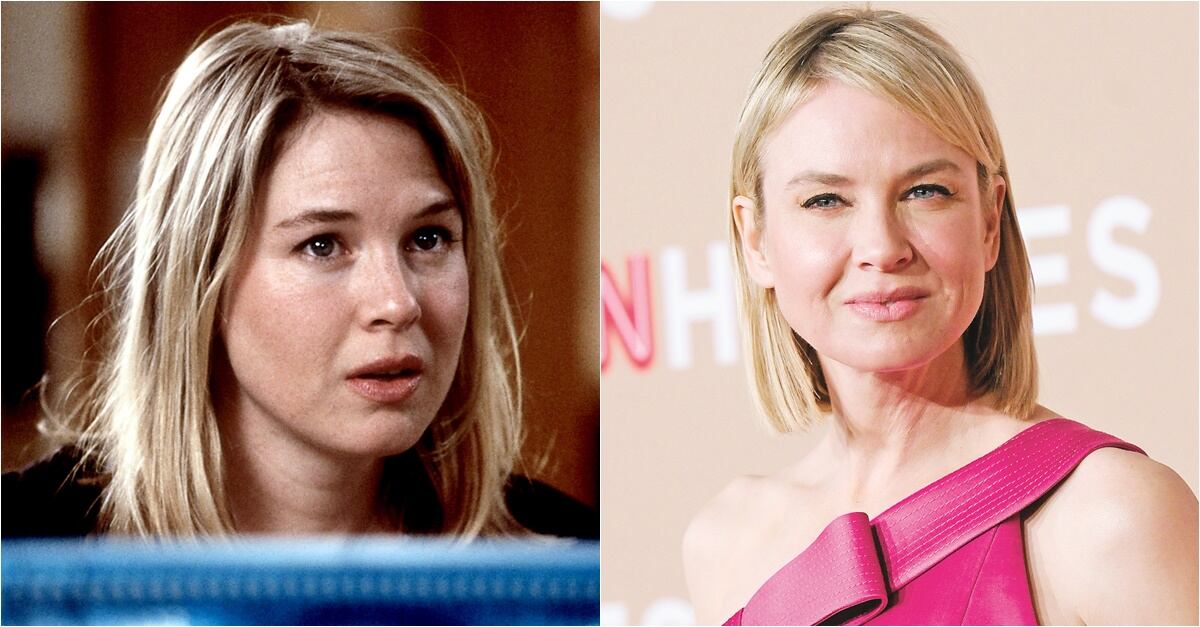 Famosos víctimas del botox 