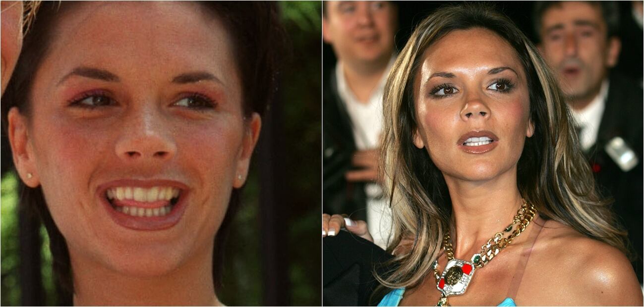 Famosos que tienen dientes postizos y no sabías