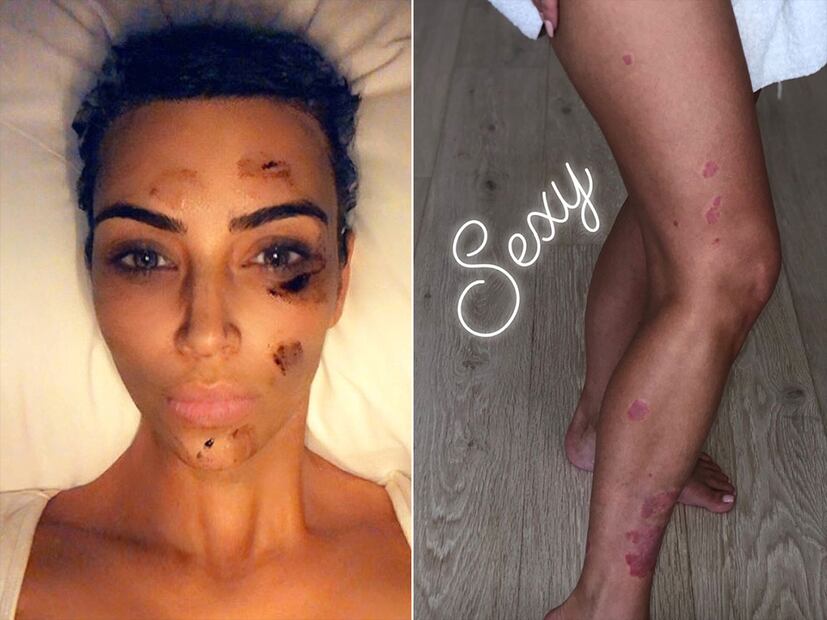 Kim Kardashian comparte foto de su rostro con psoriasis