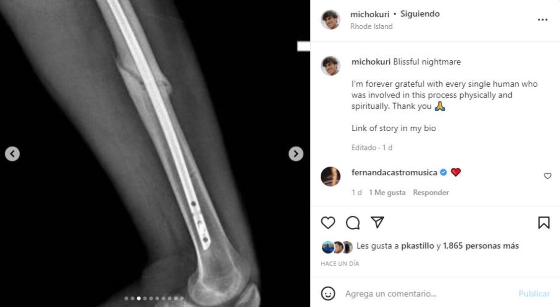 Micho Kuri: “La decisión más estúpida de mi vida”, sobre su accidente