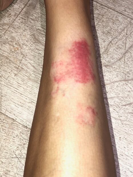Kim Kardashian comparte impactantes imágenes de su cuerpo con psoriasis