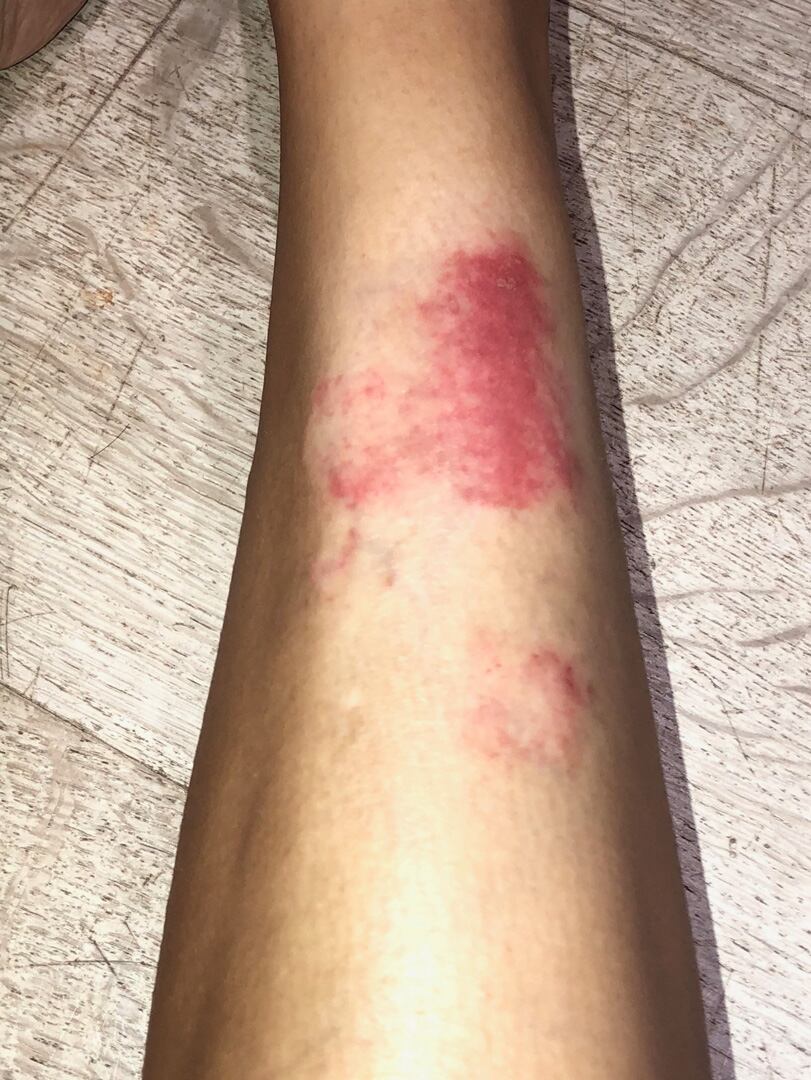Kim Kardashian comparte impactantes imágenes de su cuerpo con psoriasis