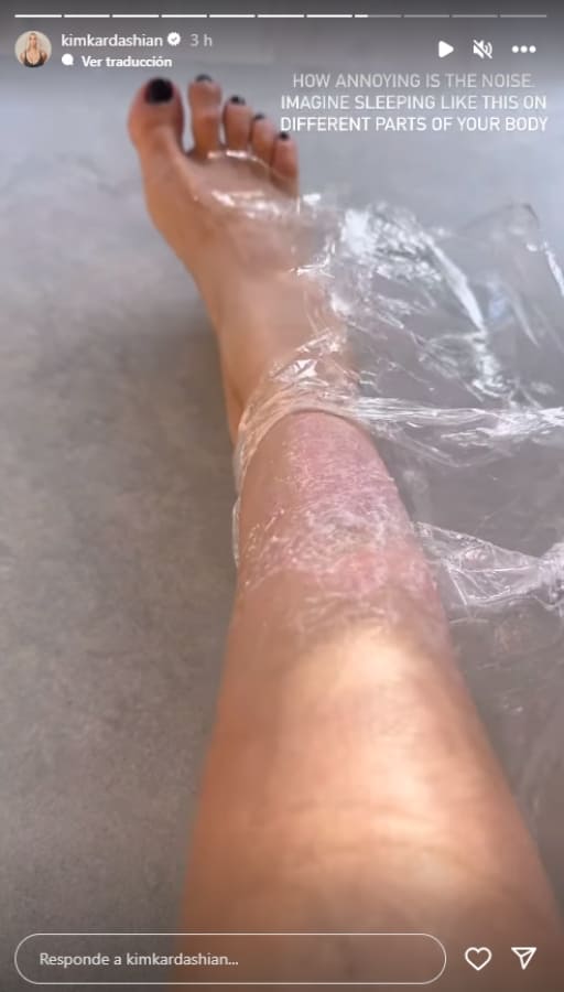 Kim Kardashian comparte fotos de su pierna con psoriasis / Instagram