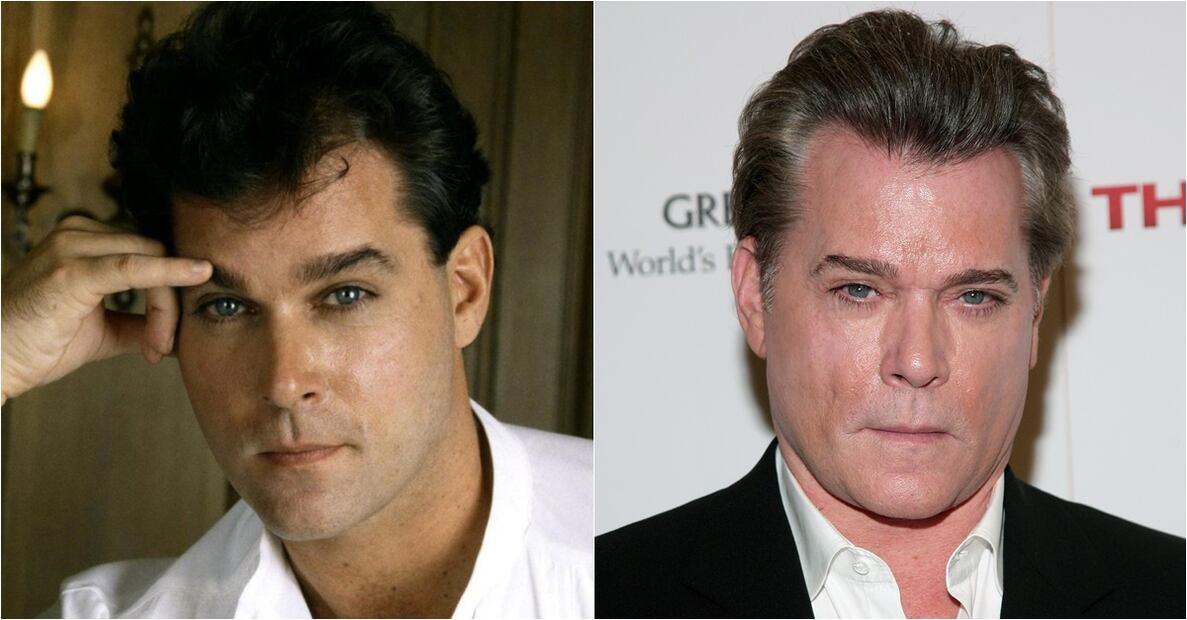 Famosos víctimas del botox 