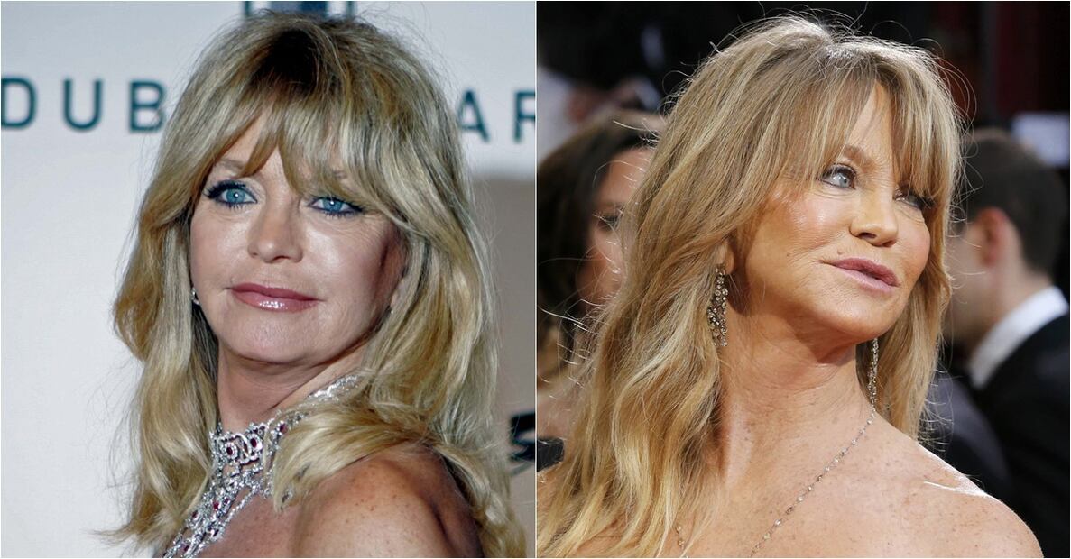Famosos víctimas del botox 