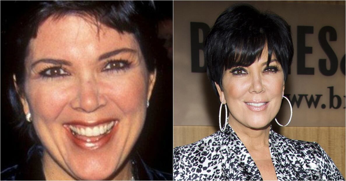 Las Kardashian antes y después del quirófano