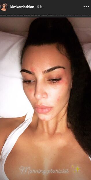 Kim Kardashian comparte foto de su rostro con psoriasis