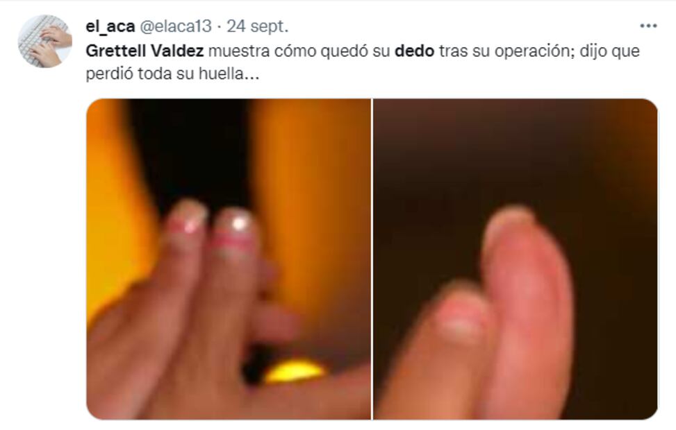 Grettell Valdez enseña su dedo afectado y habla sobre su proceso contra el cáncer