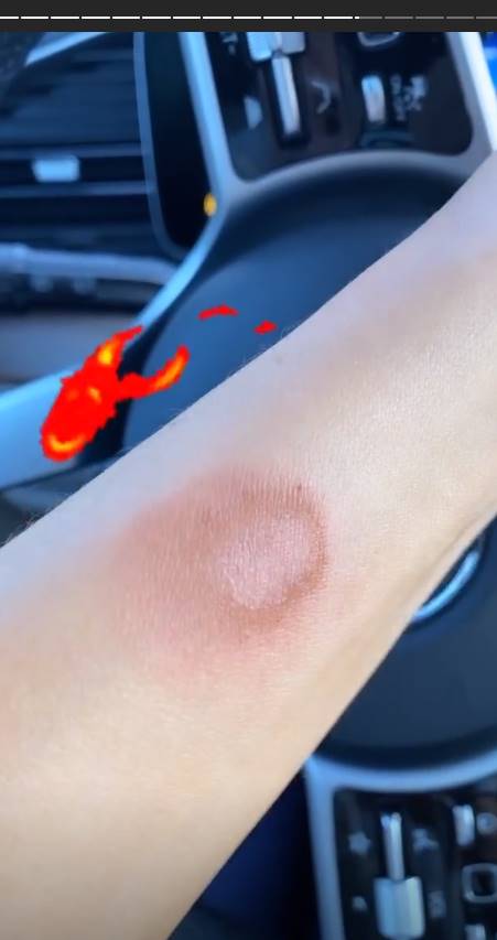 Thalía sufre doloroso accidente que le dejó un brazo quemado