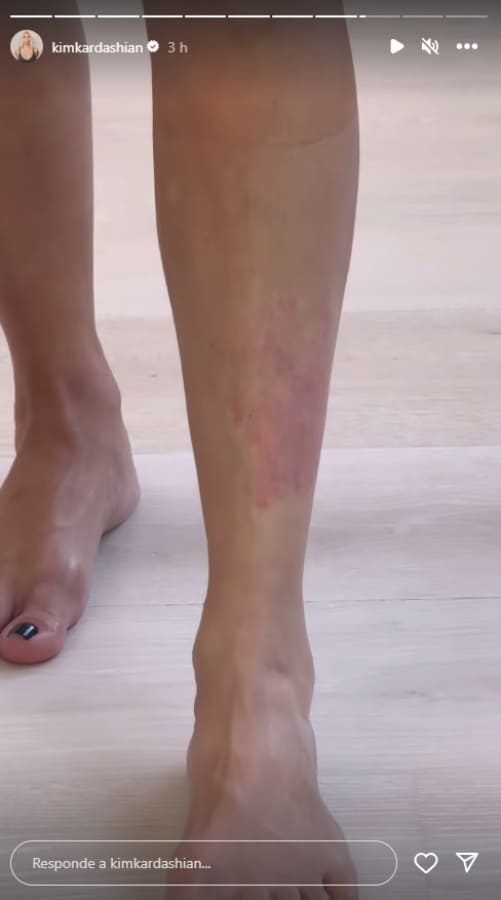 Kim Kardashian comparte fotos de su pierna con psoriasis / Instagram