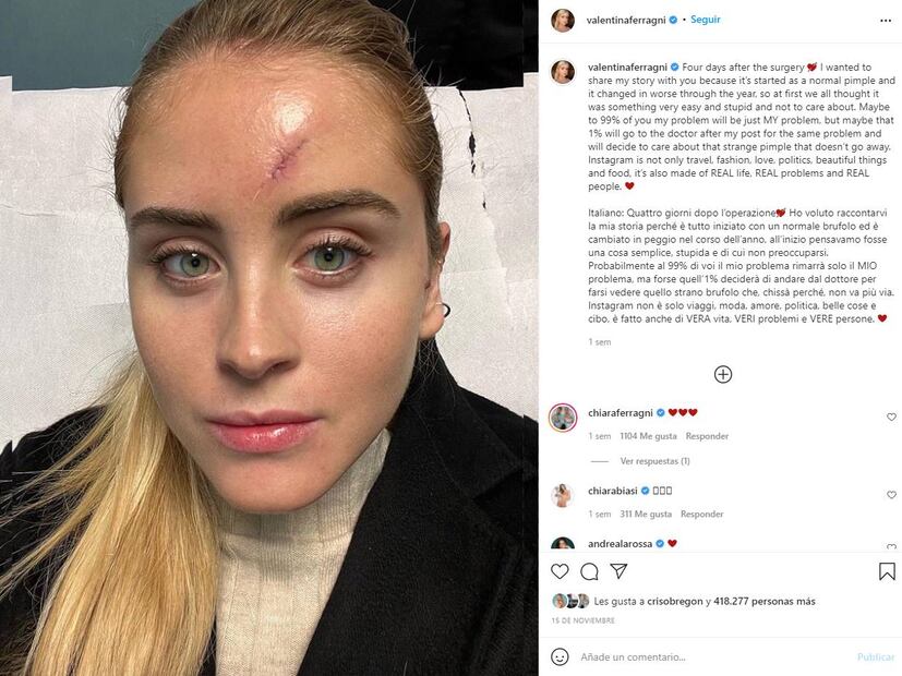 Valentina Ferragni, hermana de Chiara, revela que padece cáncer de piel
