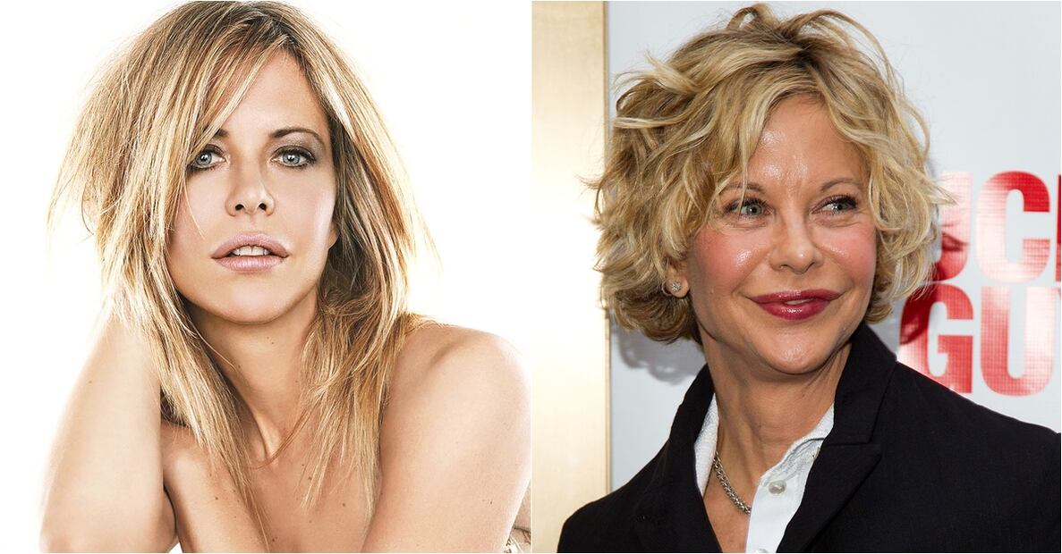 Famosos víctimas del botox 