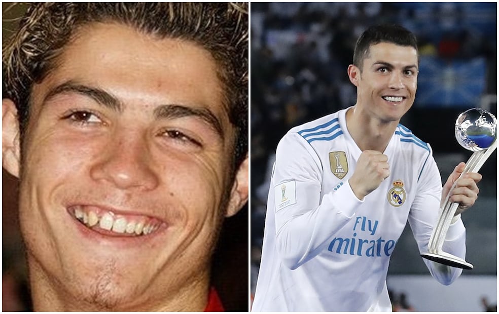 FOTOS: Antes y después de futbolistas que se operaron el rostro