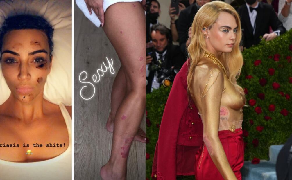 Kim Kardashian, el príncipe Harry y otros famosos con acné, psoriasis, rosácea y otras enfermedades de la piel